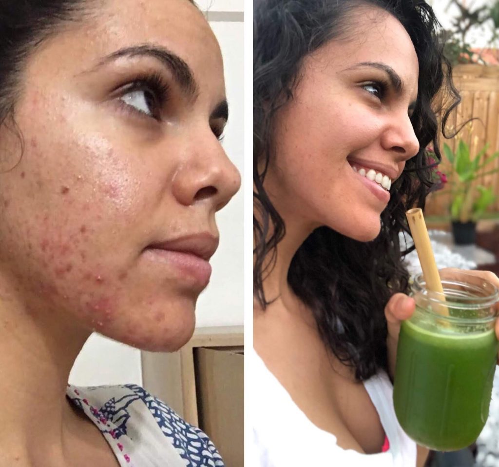 Natural Cure Rosacea, The Medical Medium “Protocol” & Celery Juice