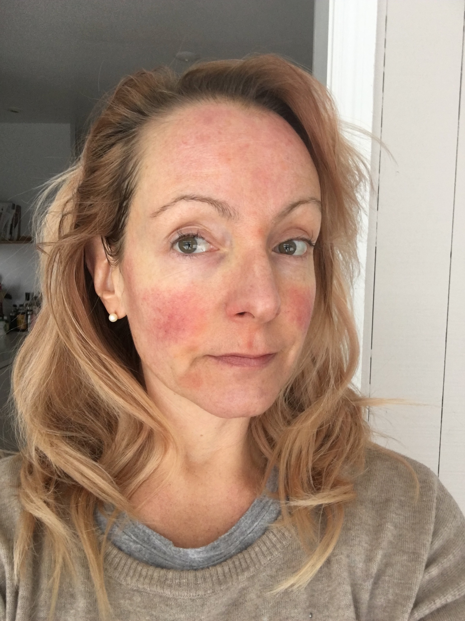 My 30 Day Medical Medium Celery Juice Challenge Resulting Skin Crisis Journey To Glow