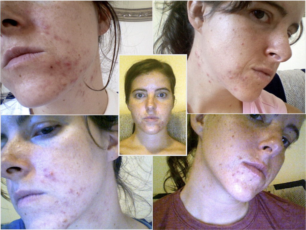 https://journeytoglow.com/wp-content/uploads/2020/08/Healing-Acne-Caused-by-Fluoride-Melissa-Gallico-before-pictures.jpeg