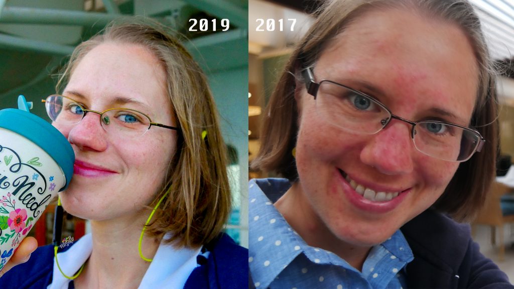 Rosacea Medical Medium Journey to Glow Before After Eva