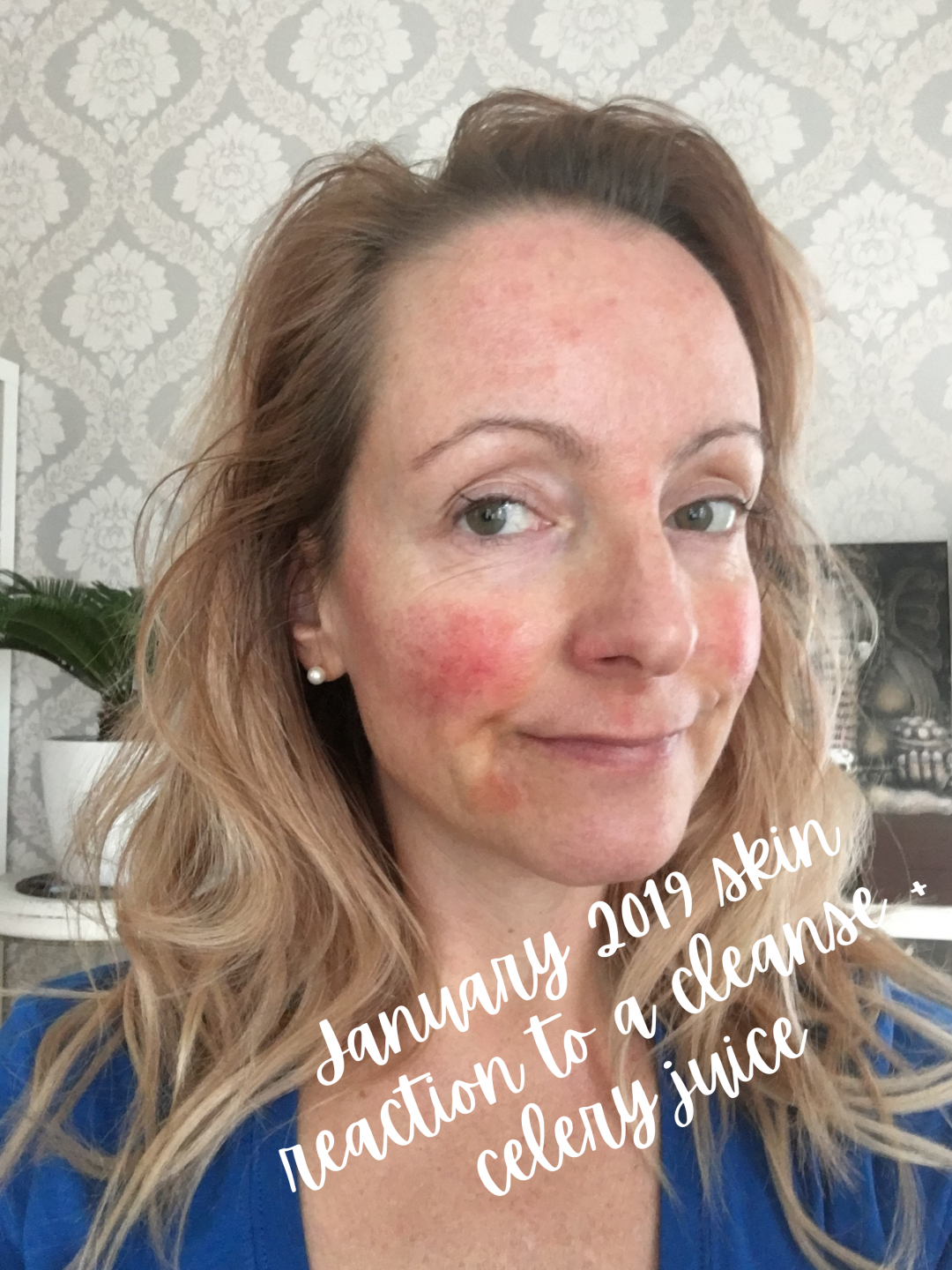 My 30Day Medical Medium Celery Juice Challenge & Resulting Skin Crisis Journey To Glow