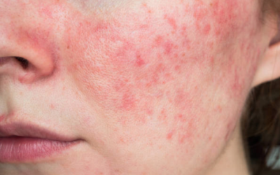 The Effects of Demodex Mites on Rosacea: Natural Solutions and Botanical Skincare Recommendations