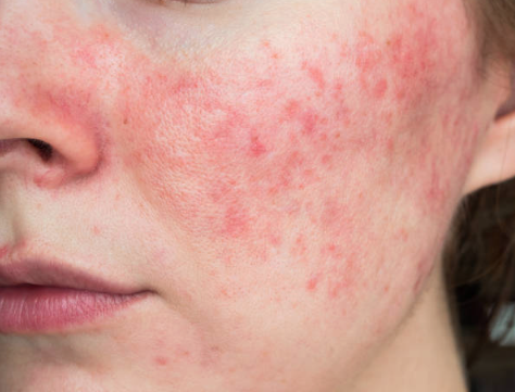 The Effects of Demodex Mites on Rosacea: Natural Solutions and Botanical Skincare Recommendations