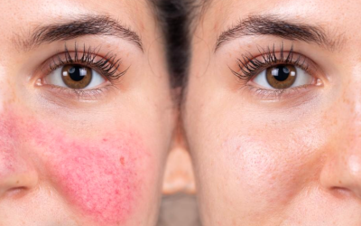 How Alkalinity Could Be the Key to Healing Rosacea